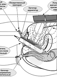 Gyno 2